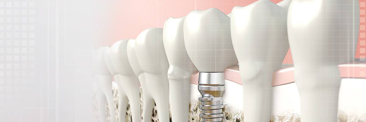 Irvine Dental Prosthetics