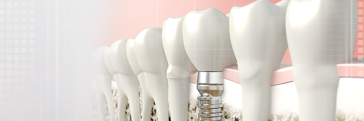 Irvine Implant Dentist