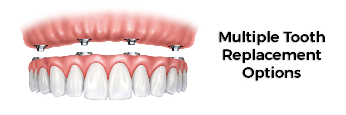 Irvine Multiple Teeth Replacement Options